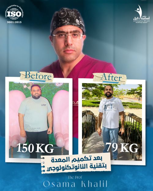 ما هي نسبة نجاح عملية تكميم المعدة
